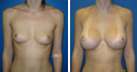 Before & After Photos